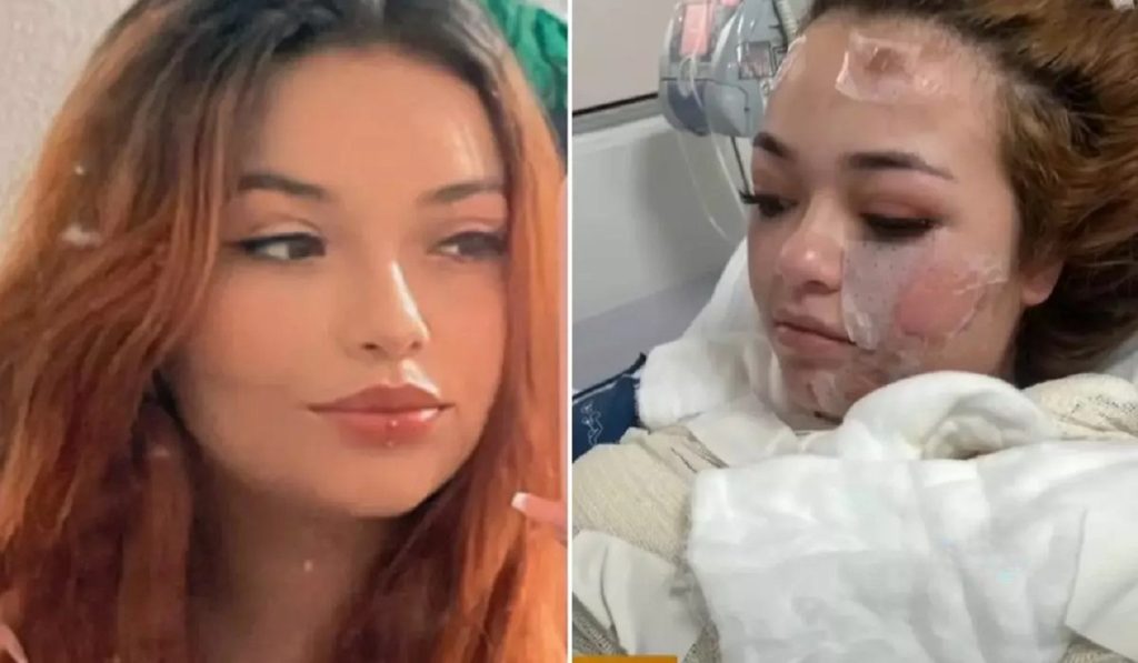 Morre no hospital jovem que sofreu queimaduras graves em banheira de motel no Paraná