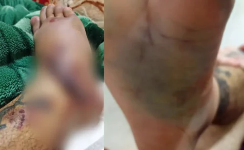 Ciclista atropelado após confusão no trânsito nega tijolada: ‘Jogou o carro pra cima de mim’