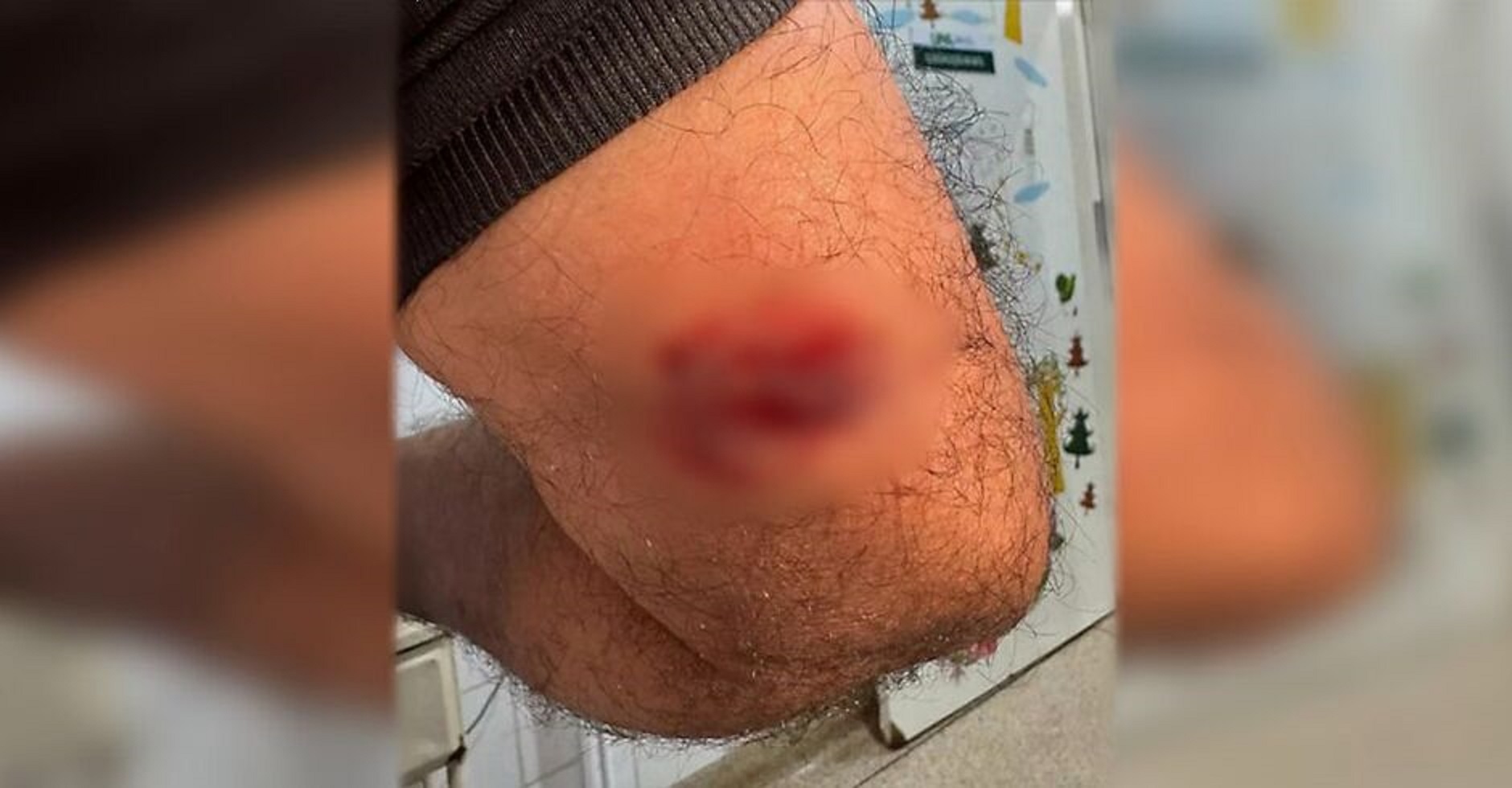 Servidor leva mordida no braço de paciente em surto na UPA