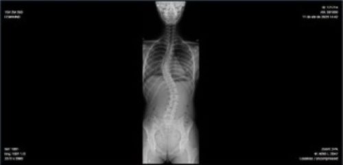 Dia da Prevenção à Escoliose, celebrado em 27 de junho, chama atenção para diagnóstico precoce e cuidados com a coluna Dia da Prevenção à Escoliose, celebrado em 27 de junho, chama atenção para diagnóstico precoce e cuidados com a coluna