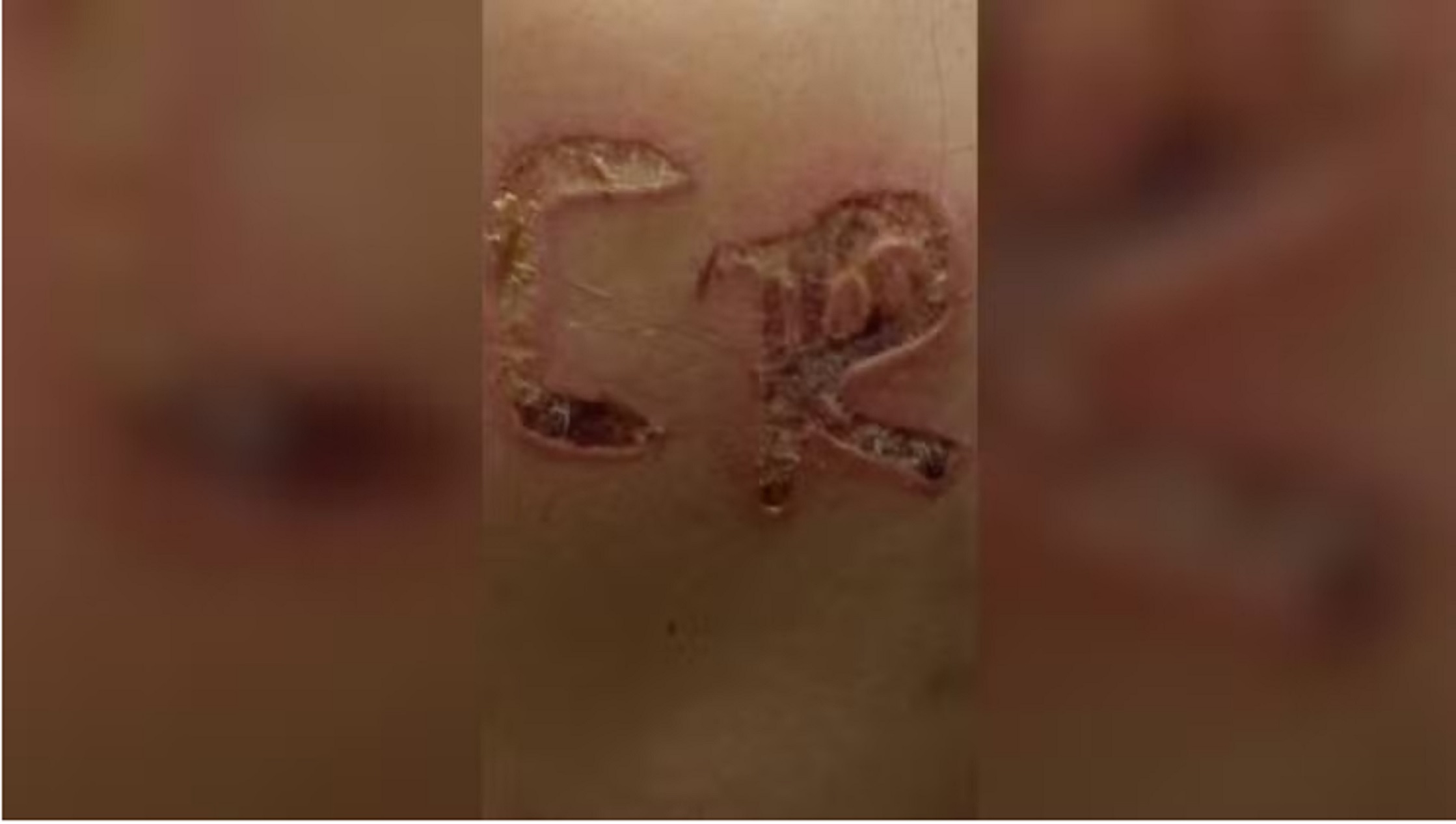 Marido é preso após marcar iniciais no corpo da esposa com ferro quente