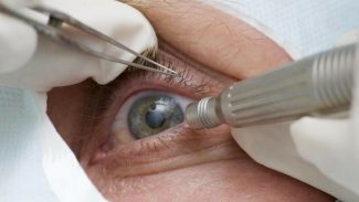 Cirurgia que altera cor do olho tem uso restrito para pessoas cegas