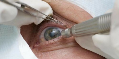 Imagem referente a Cirurgia que altera cor do olho tem uso restrito para pessoas cegas
