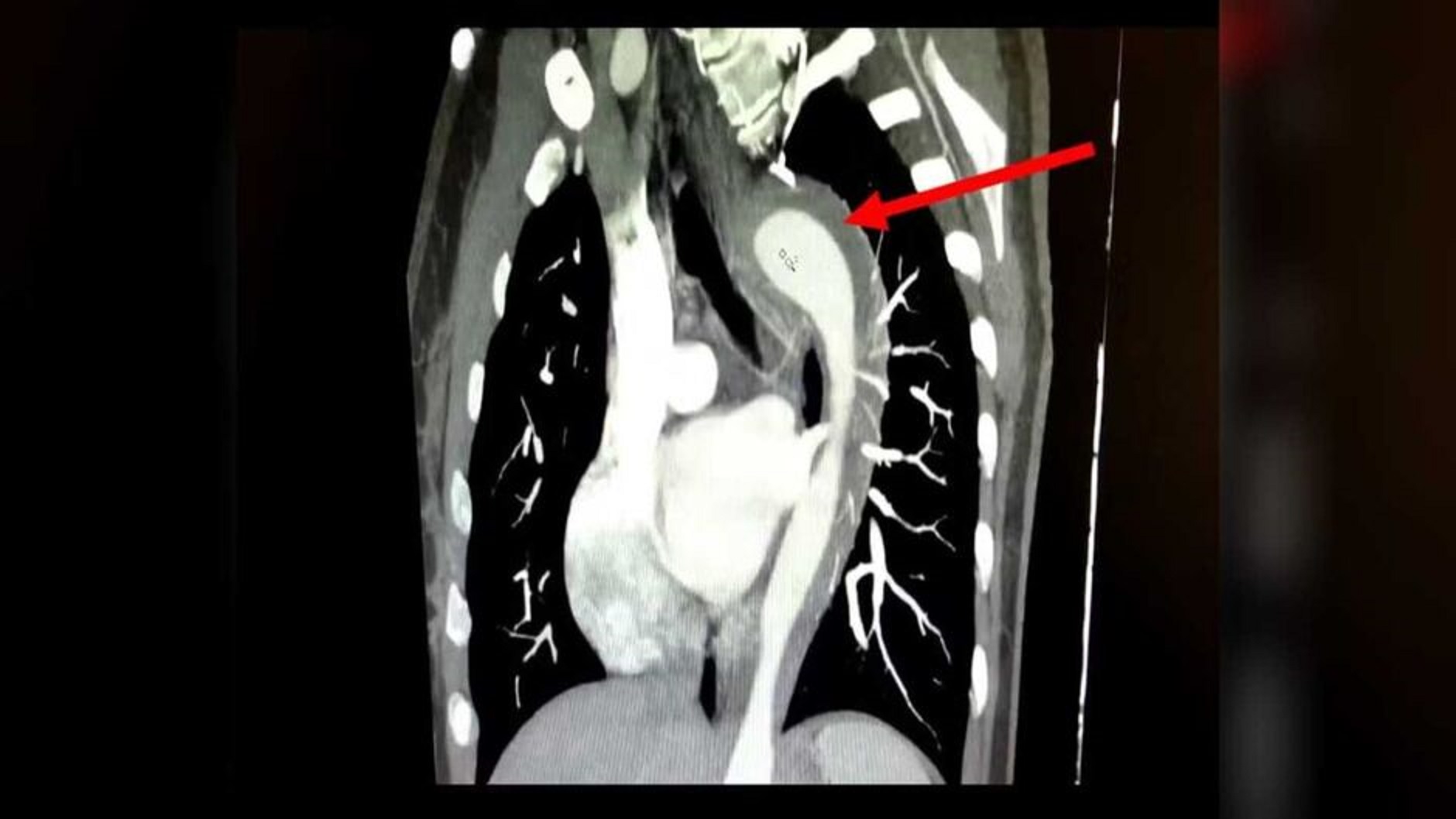 Orgasmo quase fatal: mulher rompe aorta durante sexo e vai parar no hospital Orgasmo quase fatal: mulher rompe aorta durante sexo e vai parar no hospital