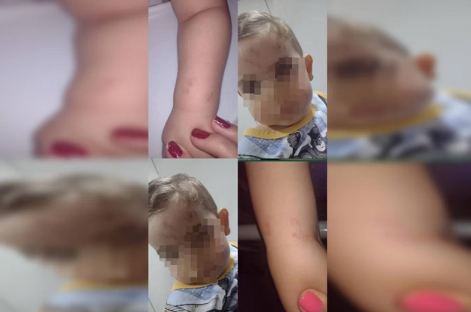 Mãe denuncia creche por mordidas em bebê