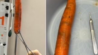 Registro interno mostra legume removido de esfíncter anal de paciente após caso inusitado em UPA