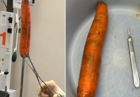 Registro interno mostra legume removido de esfíncter anal de paciente após caso inusitado em UPA Imagem referente a Registro interno mostra legume removido de esfíncter anal de paciente após caso inusitado em UPA