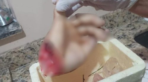 Homem tem mão decepada ao se envolver em briga de facão Imagem referente a Homem tem mão decepada ao se envolver em briga de facão