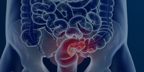 Imagem referente a Estudo projeta aumento de 36% em mortes por câncer colorretal até 2040