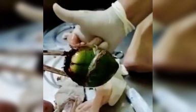 Imagem referente a “Bumbum Tropical”: vaza vídeo de cirurgia para remoção de coco verde de ânus de paciente