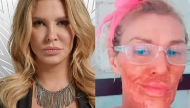 Imagem referente a Ex-modelo Brandi Glanville sofre queimaduras no rosto ao tentar eliminar parasita com método caseiro