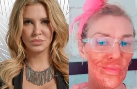 Ex-modelo Brandi Glanville sofre queimaduras no rosto ao tentar eliminar parasita com método caseiro Ex-modelo Brandi Glanville sofre queimaduras no rosto ao tentar eliminar parasita com método caseiro