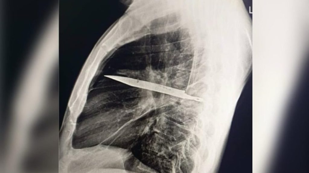 Homem sente dor no peito e descobre faca alojada no corpo há 8 anos