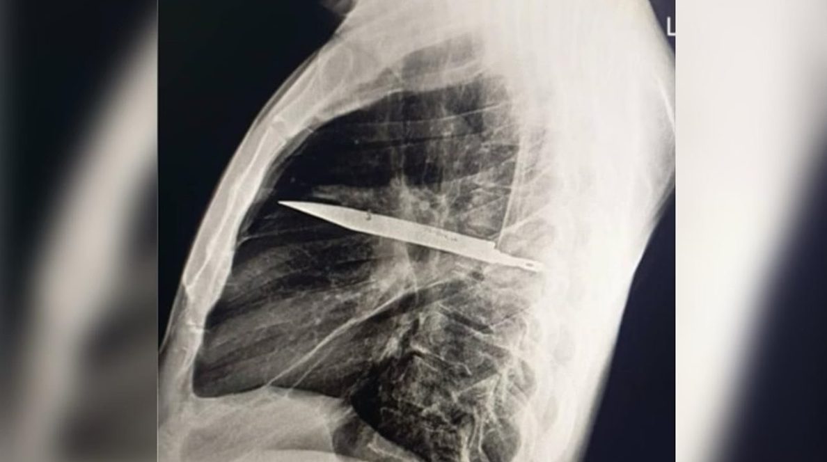 Homem sente dor no peito e descobre faca alojada no corpo há 8 anos