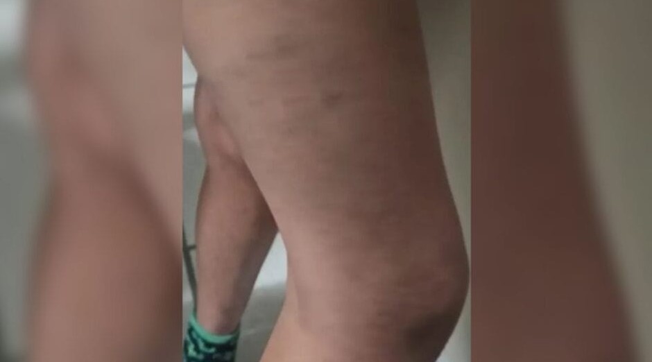 Pais adotivos usavam espeto de churrasco e pau para torturar filhos