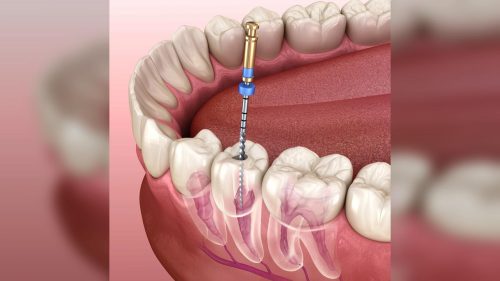 Cascavelense acusa clínica de deixar ‘lima quebrada’ no dente, mas Justiça diz: ‘tudo dentro dos padrões’ Imagem referente a Cascavelense acusa clínica de deixar ‘lima quebrada’ no dente, mas Justiça diz: ‘tudo dentro dos padrões’