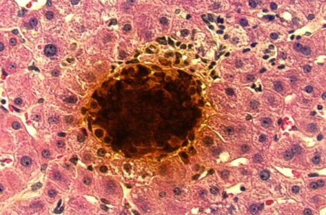 É o fim da diabetes?: Novo transplante faz idoso abandonar injeção de insulina após décadas É o fim da diabetes?: Novo transplante faz idoso abandonar injeção de insulina após décadas