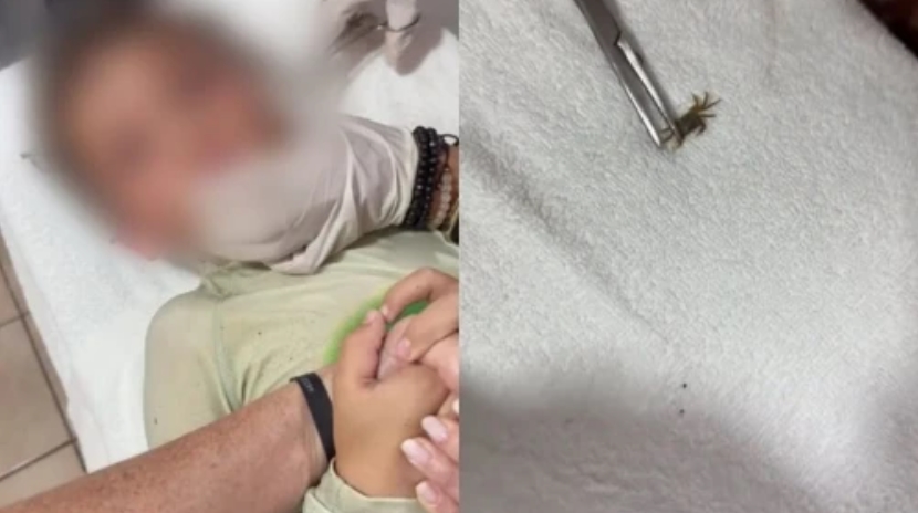 Menino surpreende médicos ao ter caranguejo vivo retirado do ouvido após mergulho no mar