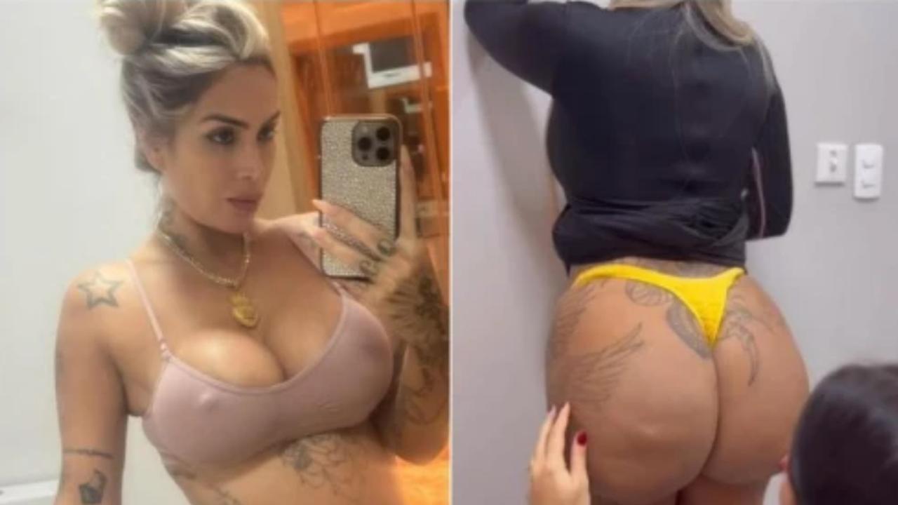 Influenciadora sofre vazamento de hidrogel do bumbum em estado de decomposição