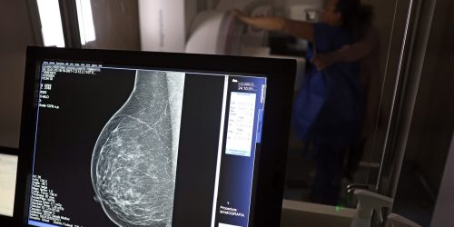 Guerra ao câncer de mama: Brasil une forças pela prevenção e diagnóstico precoce Guerra ao câncer de mama: Brasil une forças pela prevenção e diagnóstico precoce