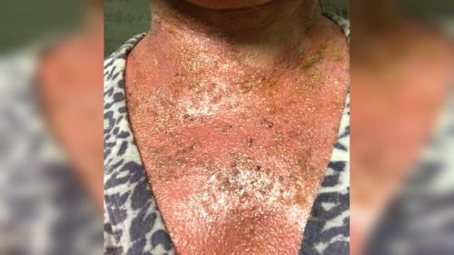 Farmacêutico é denunciado e vira réu após paciente relatar queimaduras graves durante peeling em Cascavel