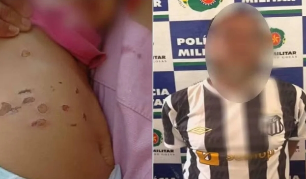 Padrasto é suspeito de queimar bebê com cigarro no Entorno do DF