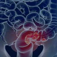 Imagem referente a Pacientes com câncer colorretal são diagnosticados em estágio avançado