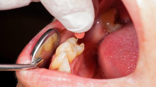 Idosa fica com sequela permanente após cirurgia em Cascavel Imagem referente a Idosa fica com sequela permanente após cirurgia em Cascavel