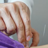 Imagem referente a Brasil regulamenta exercício profissional da acupuntura