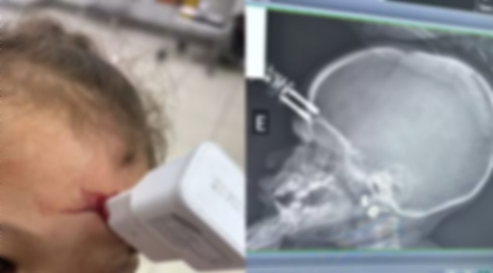 Menina de 1 ano passa por cirurgia de urgência após queda com carregador cravado na testa