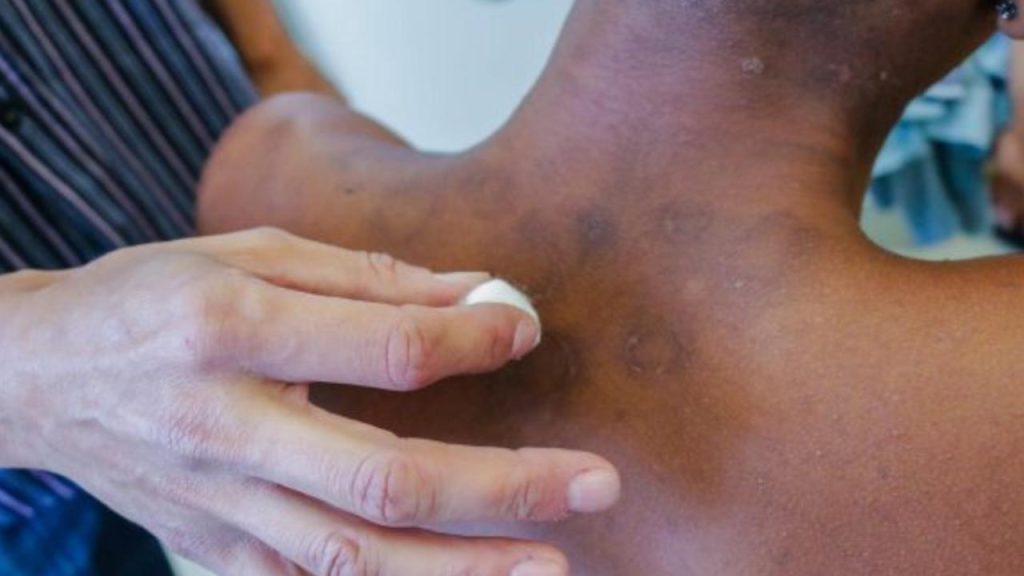 Hanseníase: Entenda a doença e como tratar Hanseníase: Entenda a doença e como tratar