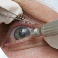 Lula faz cirurgia de catarata; entenda a doença e o procedimento Imagem referente a Lula faz cirurgia de catarata; entenda a doença e o procedimento