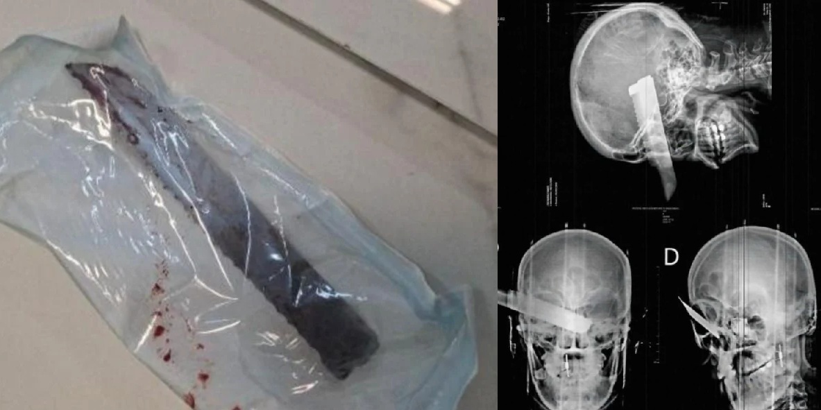 Raio-X mostra gravidade de ataque a mulher em tentativa de feminicídio Raio-X mostra gravidade de ataque a mulher em tentativa de feminicídio