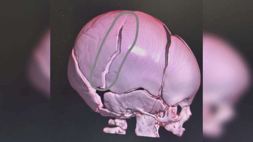 PCPR investiga lesão corporal grave contra bebê de dois meses em Santa Tereza do Oeste