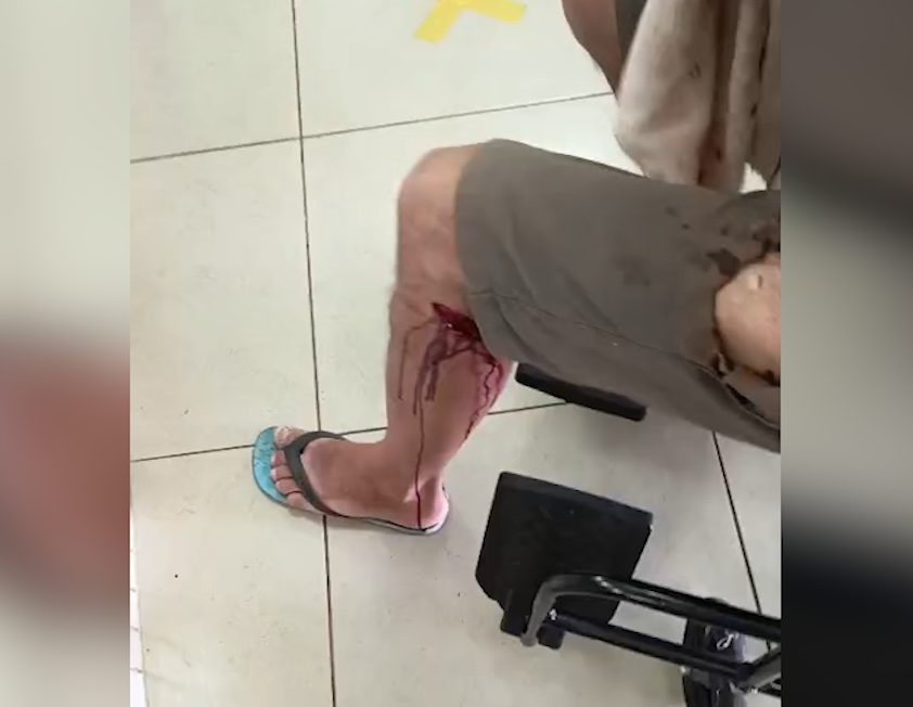 Imagens mostram laceração de homem atacado por animal e buraco no shorts provocado por explosão de iPhone