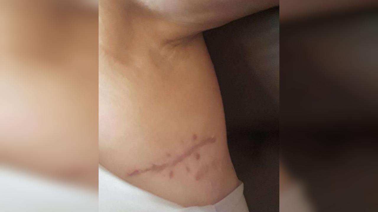 Após ser esfaqueada no pescoço em casa, mulher sobrevive e lida com desafios diários
