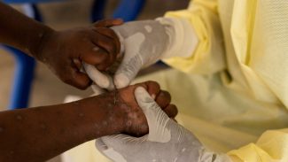 Brasil registra 88 casos de Mpox em 2026; saiba como evitar a doença