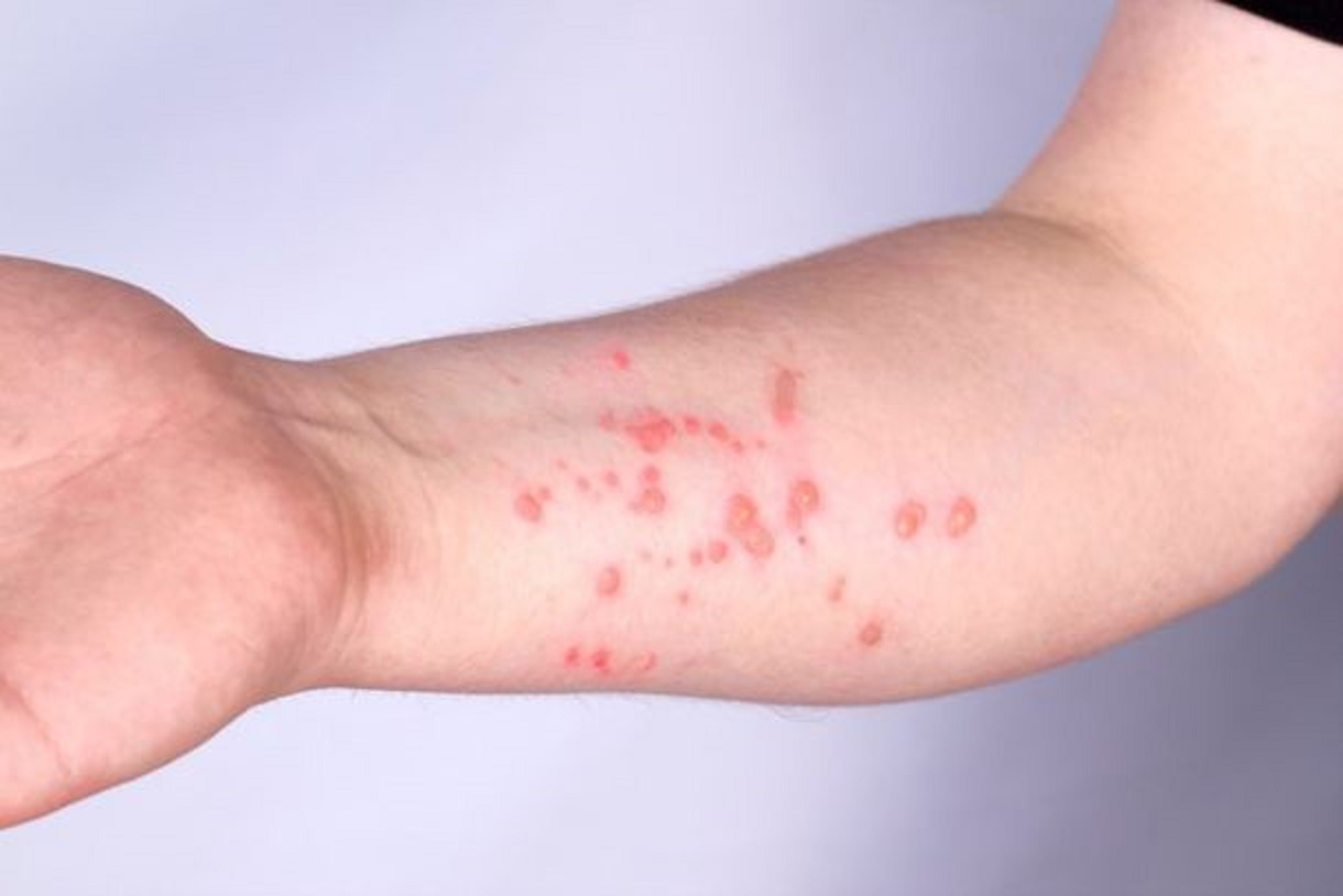 Paraná confirma primeiro caso de mpox em 2026 após atendimento em Foz do Iguaçu