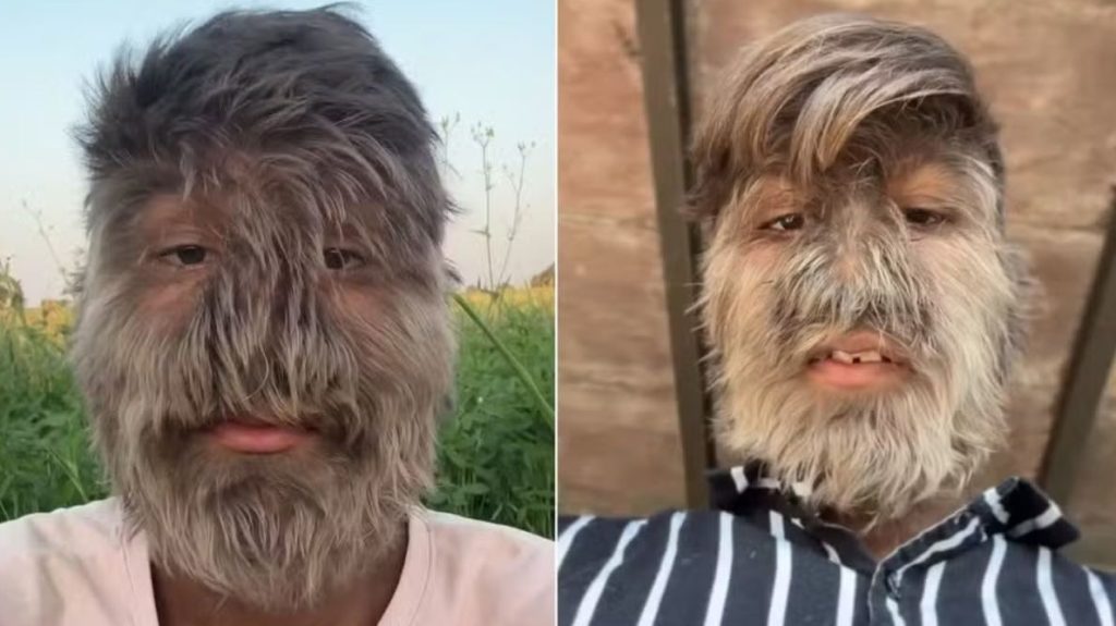 Jovem com “síndrome do lobisomem” vira influenciador e conquista milhares de seguidores