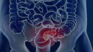 Rastreamento para câncer colorretal pode ser implementado no SUS