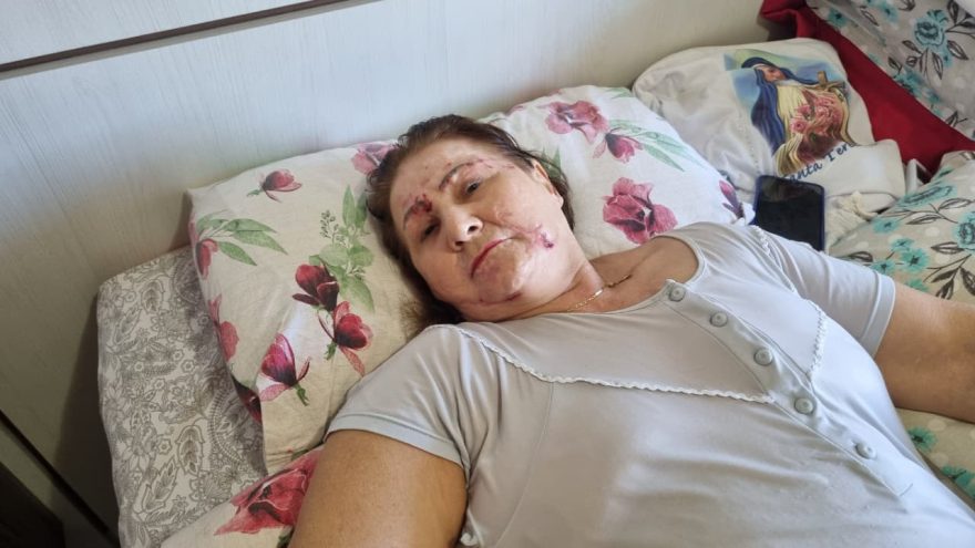 Acamada após atropelamento por ônibus, idosa conta como ocorreu acidente