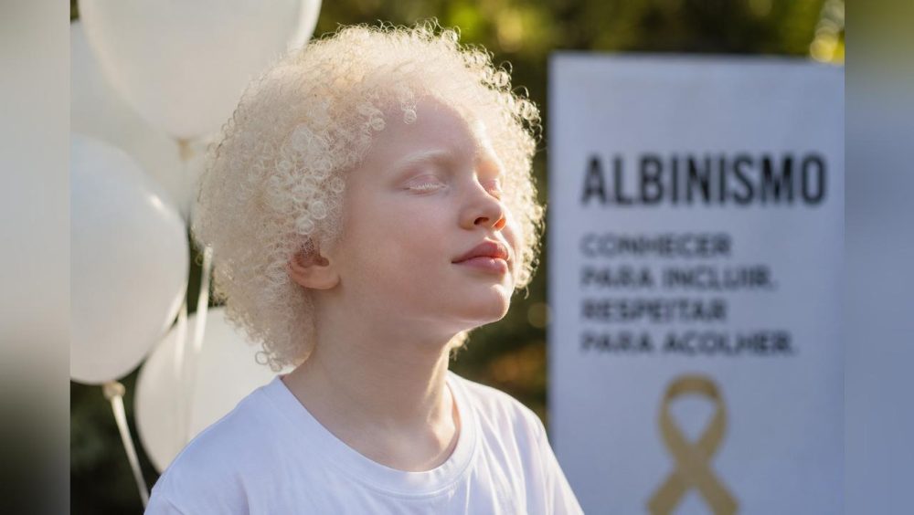 Dia Internacional de Conscientização sobre o Albinismo combate preconceitos e promove inclusão Imagem referente a Dia Internacional de Conscientização sobre o Albinismo combate preconceitos e promove inclusão