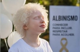 Dia Internacional de Conscientização sobre o Albinismo combate preconceitos e promove inclusão Dia Internacional de Conscientização sobre o Albinismo combate preconceitos e promove inclusão