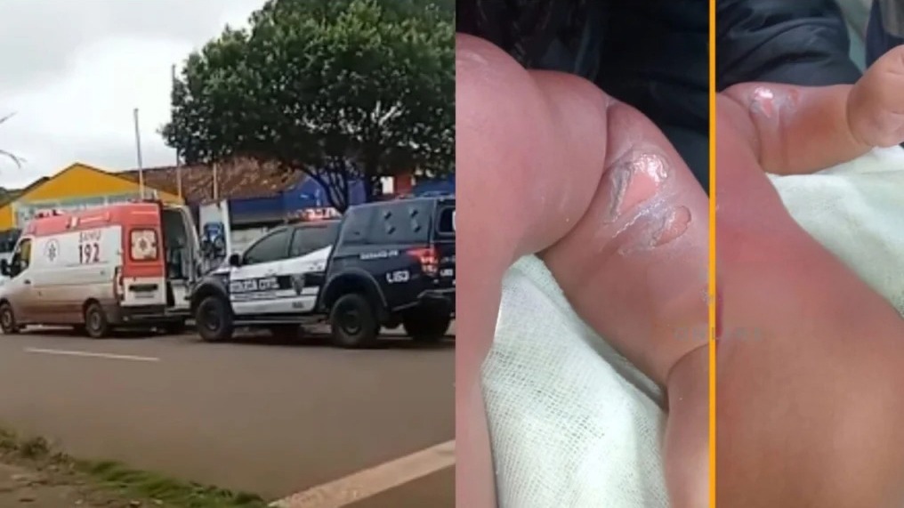Imagem relativa a Bebê de 9 meses sofre queimaduras graves durante banho em CMEI no PR e é levado às pressas para cirurgia