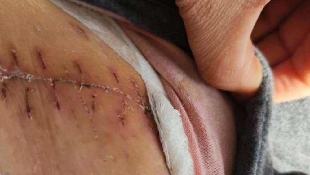 Mulher com câncer processou médico e clínica de Cascavel após ureter ser cortado durante cirurgia Imagem referente a Mulher com câncer processou médico e clínica de Cascavel após ureter ser cortado durante cirurgia