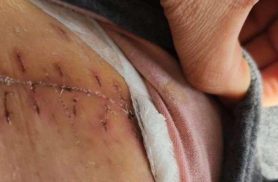 Mulher com câncer processou médico e clínica de Cascavel após ureter ser cortado durante cirurgia