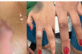 Homem ateia fogo na esposa após discussão por unhas vermelhas e é preso