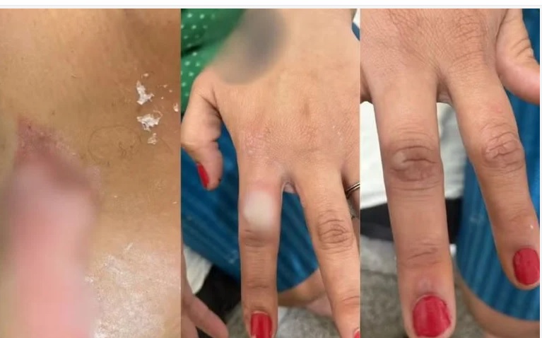 Homem ateia fogo na esposa após discussão por unhas vermelhas e é preso Imagem referente a Homem ateia fogo na esposa após discussão por unhas vermelhas e é preso