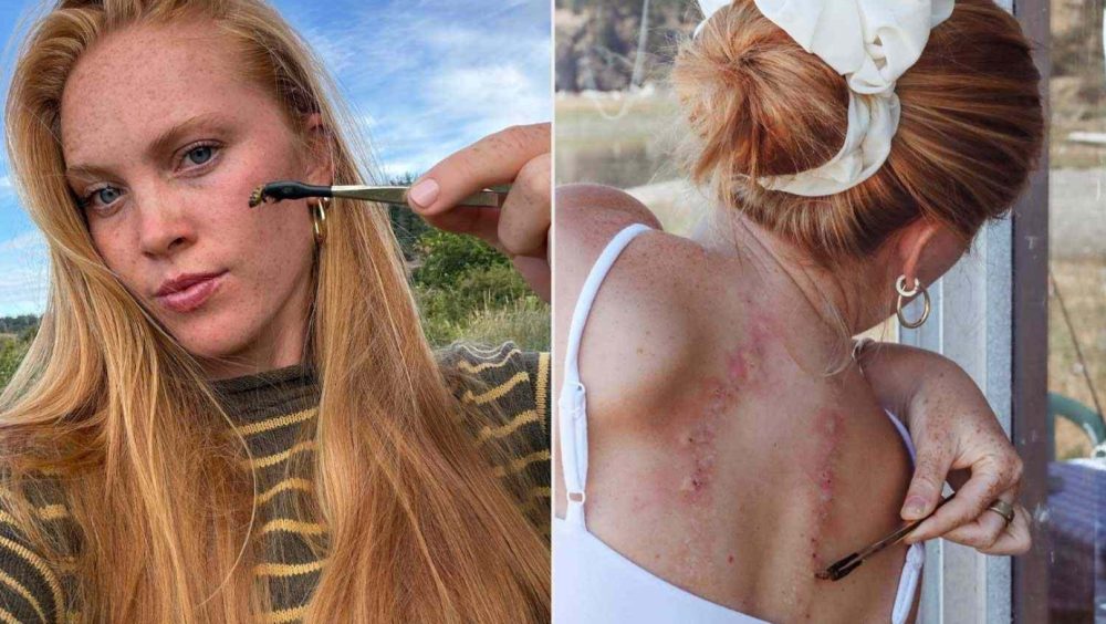 Mulher recebe 30 picadas de abelha por semana para controlar doença Imagem referente a Mulher recebe 30 picadas de abelha por semana para controlar doença