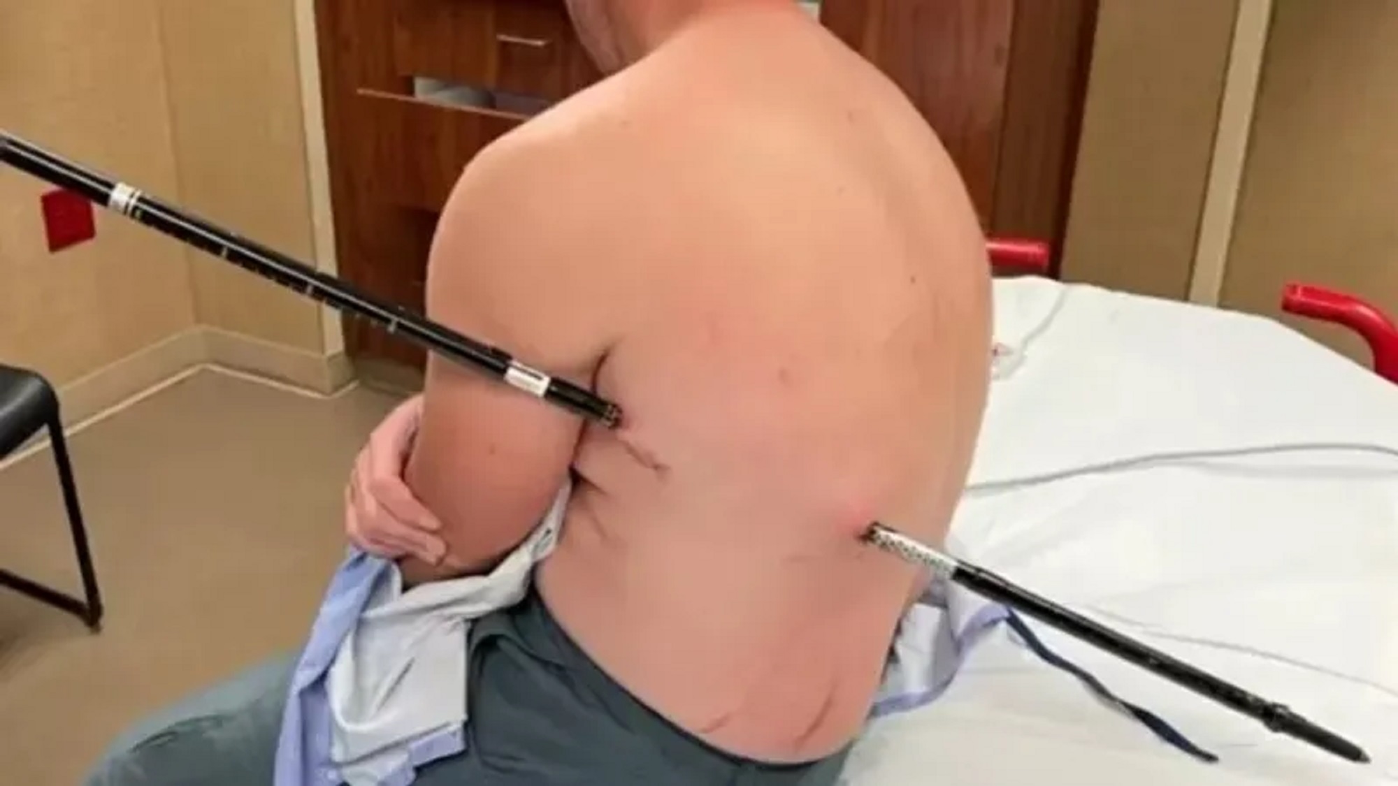 Imagem referente a Enfermeiro sobrevive após cair sobre bastão de caminhada que atravessou suas costas